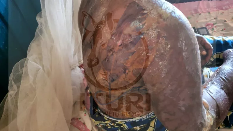 Djugu : un homme asperge de l’acide sur sa femme et sa fillette de 5 ans à Mongbwalu