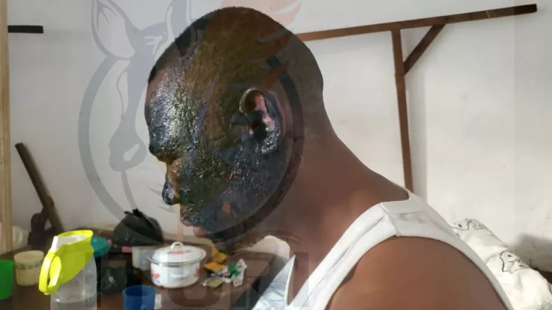 Djugu : suite à un conflit conjugal, une femme verse de l’huile chaude sur son mari à Mongbwalu